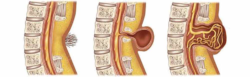 okvara-nevralne-cevi